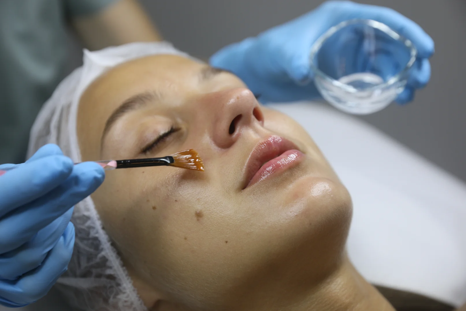 Chemical Peels